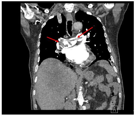 Cureus | Incidental Finding of Saddle Pulmonary Embolism on a CT Scan ...