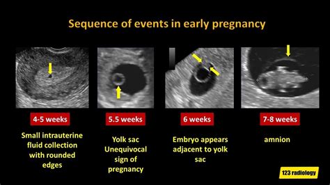 Early Pregnancy Ultrasound Measurements And Prediction Of, 58% OFF