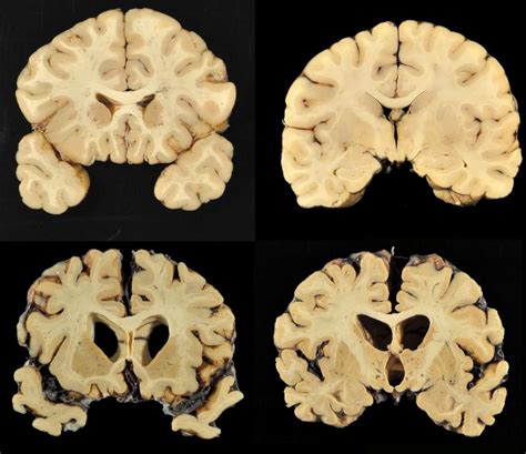 Former NFL player confirmed as 1st diagnosis of CTE in living patient | abc7.com