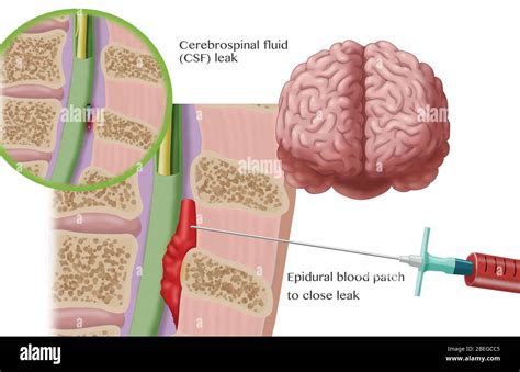 Epidural Blood Patch Procedure, Illustration Stock Photo - Alamy