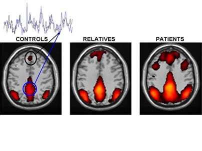 Altered brain activity in schizophrenia may cause exaggerated focus on self | MIT News ...