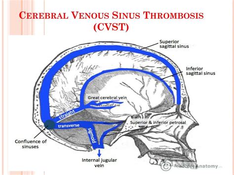 Cerebral Venous Sinus Thrombosis - PELAJARAN