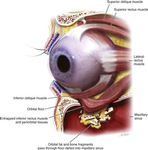 Orbital Fractures | Pocket Dentistry