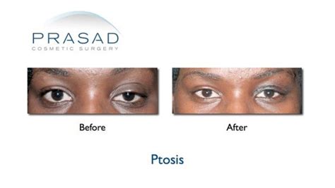 Ptosis surgery Before And After Photos | Drooping eyelid | Dr Prasad