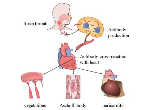 Rheumatic endocarditis RHEUMATIC HEART DISEASE Rheumatic fever is