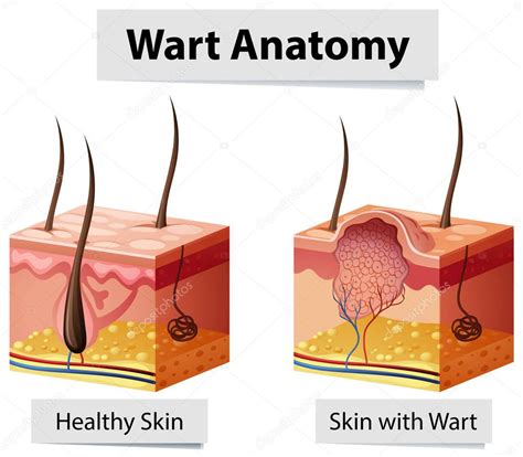 Anatomy Of A Plantar Wart