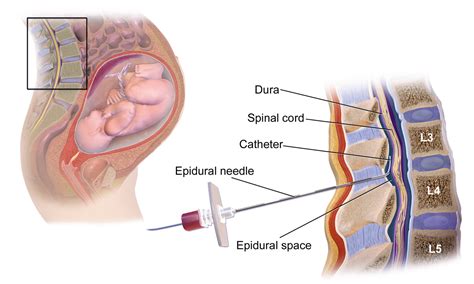 Caesarean Section - Indications - Classification - TeachMeObGyn