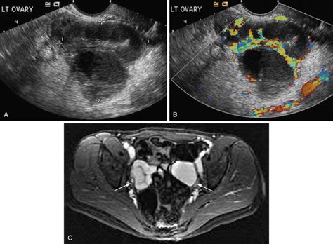 Approach to Imaging the Adnexal Mass | Radiology Key