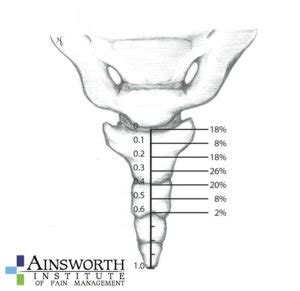 Ganglion of Impar Block - Ainsworth Institute