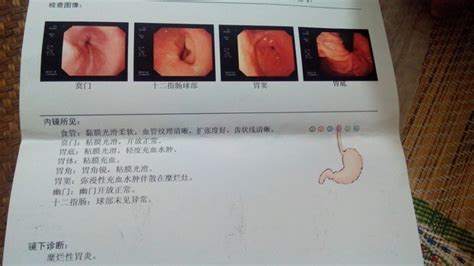 电子胃镜检查报告单 _快速问医生_免费咨询_补肾参考网