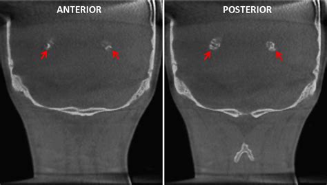 Calcificación de los Plexos Coroideos – Dento Metric | Radiología Dental, Oral y Maxilofacial