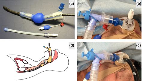 Supraglottic airway device use for transoesophageal echocardiography ...