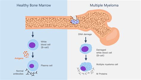 What Is Multiple Myeloma and How Can It Be Managed?