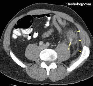 RiT radiology: Acute Sigmoid Diverticulitis