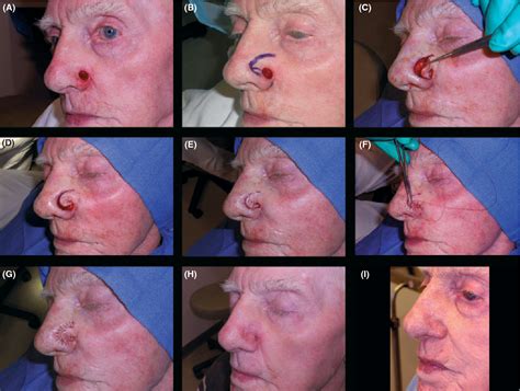 Figure 3 from The Spiral Flap for Nasal Alar Reconstruction: Our Experience with 63 Patients ...