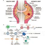 Understanding Rheumatoid Arthritis: Causes, Symptoms, and Treatments - Becker Spine