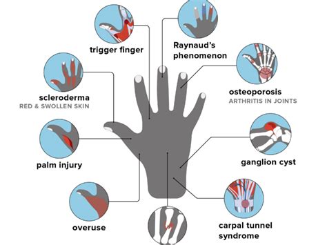 Details more than 62 metacarpophalangeal joint pain ring finger super ...