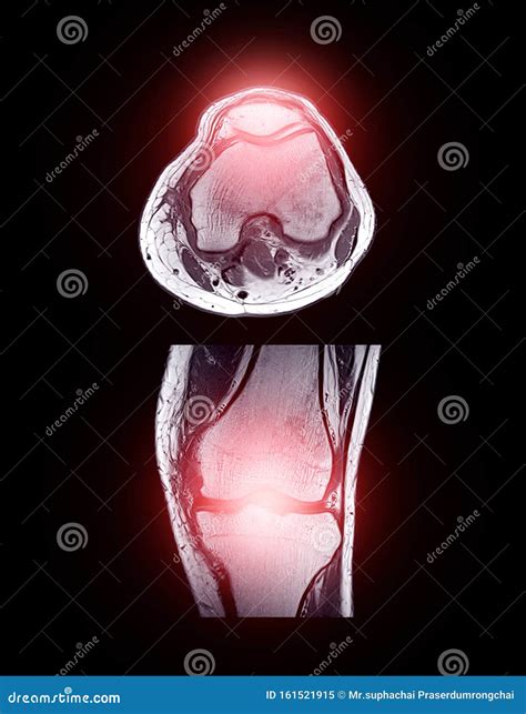 MRI Knee Joint or Magnetic Resonance Imaging . Stock Image - Image of ligaments, cartilage ...