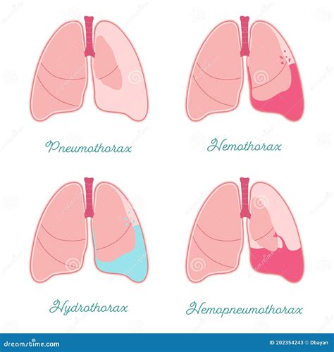 3d Illustration Of Hemothorax, Normal Lung Versus Collapsed, Symptoms ...