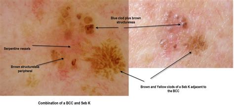 Dermatoscopy Made Simple: Pigmented BCC