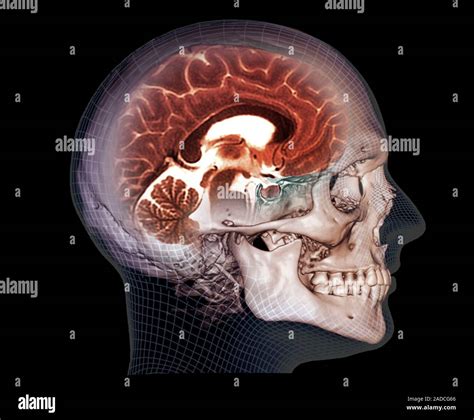 Human skull and brain. Combined coloured computed tomography (CT) and ...