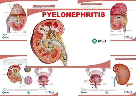 Pyelonephritis – Anejo