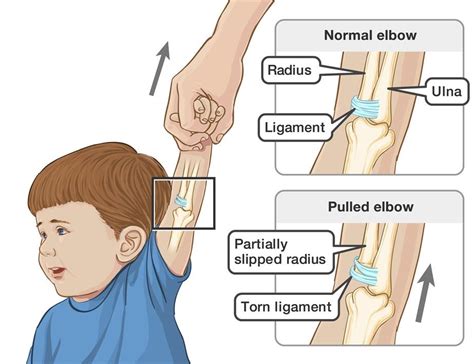 Pulled elbow – Dr Megs – Kids Health Guru