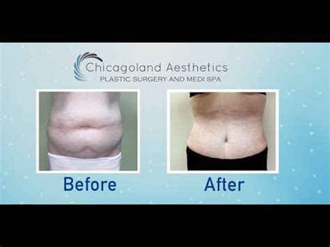 Liposuction 360 at Chicagoland Aesthetics | Plastic Surgery in Chicago ...