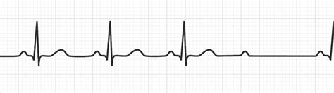 Second Degree AV Block: Type II Mobitz | Conduction Disorders - MedSchool