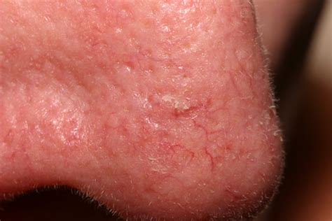 Actinic Keratosis - Causes, Symptoms & Actinic Keratosis Treatment