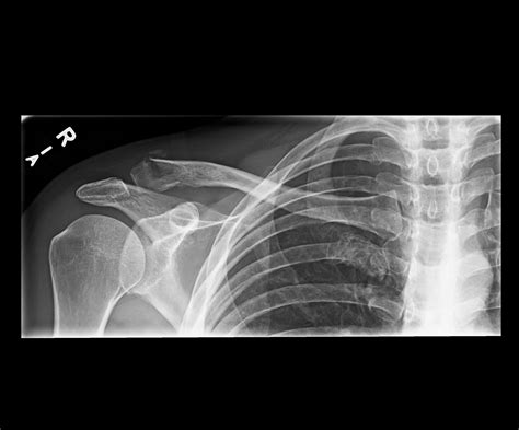 OrthoDx: Lateral Clavicle Fracture - Clinical Advisor