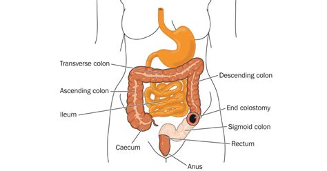 Colostomy surgery for IBD | IBDrelief