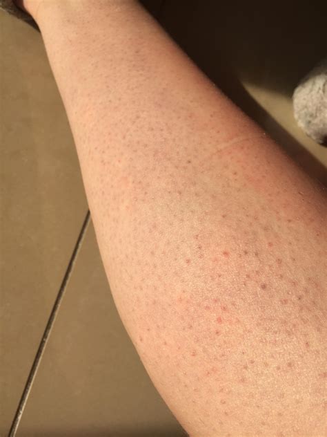 [Skin Concerns] How do I get rid of these bumps on my legs? : r/SkincareAddiction