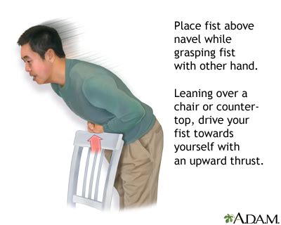 Heimlich maneuver on self | UF Health, University of Florida Health