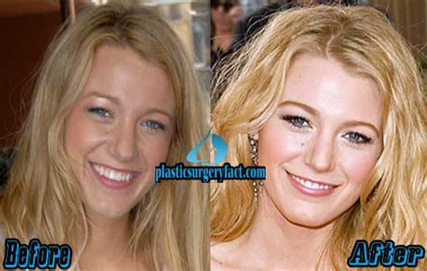 Blake Lively Plastic Surgery Before and After Photos