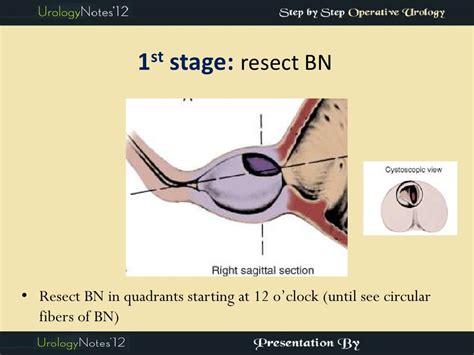 TURP step by step operative urology