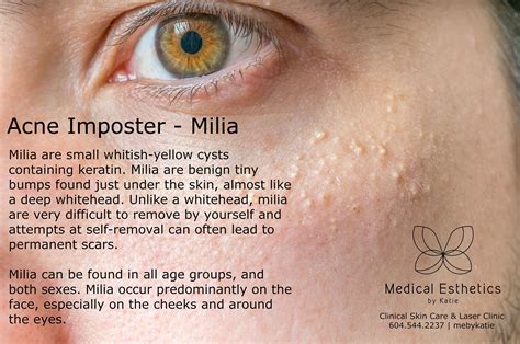 What Causes Milia? There are several factors that cause milia in adults ...