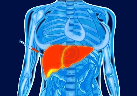 Learn About The Liver Biopsy & Its Procedure - The GI Docs