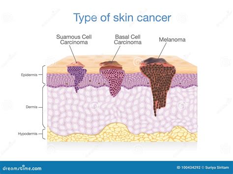 Skin Cancer. Squamous Cell Carcinoma, Basal-cell Cancer And Melanoma. Cartoon Vector ...