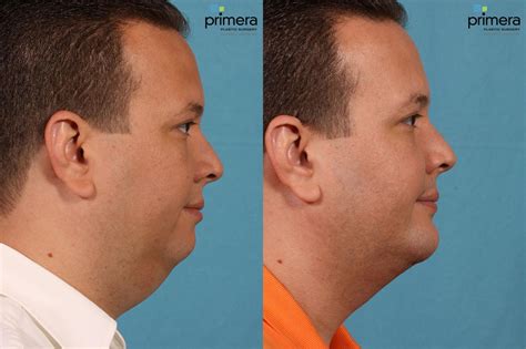 Neck & Face Liposuction Before & After Photos Patient 73 | Orlando ...