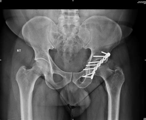 Acetabular Reconstruction