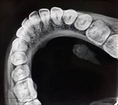 Occlusal x-rays – Mediatrix