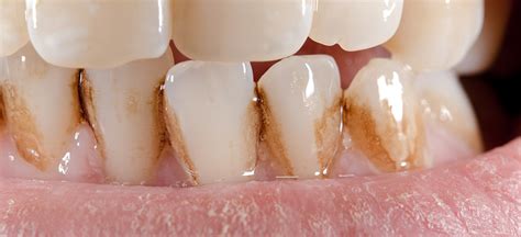 Possible Reasons For Stained or Dis-colored Teeth | Monash Dental Group