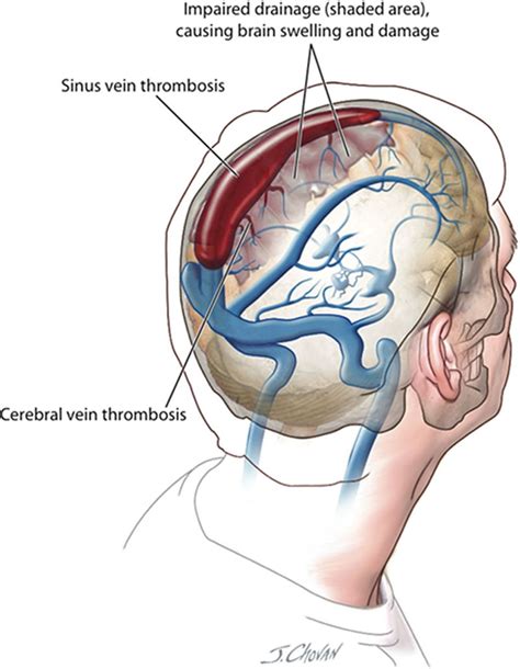 Cerebral and Sinus Vein Thrombosis | Circulation