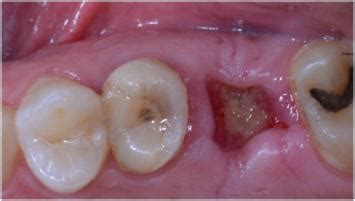 What Should A Tooth Extraction Look Like When Healing - All You Need Infos