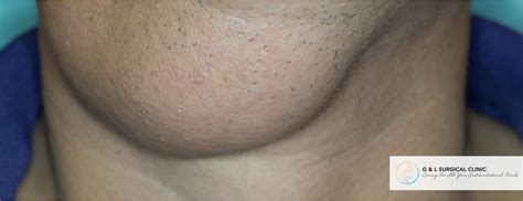 Neck Lipoma Removal | Cost Effective Lipoma Removal in Singapore