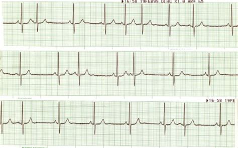 Wandering Atrial Pacemaker Rhythm Strip