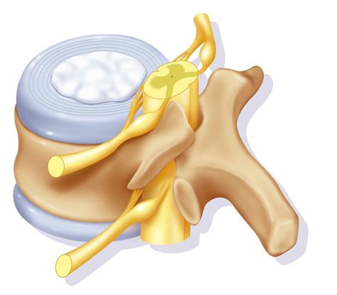 disque intervertebral | Lombafit