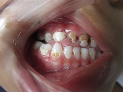 Tooth Decay in Children:The unanswered truth | Medchrome