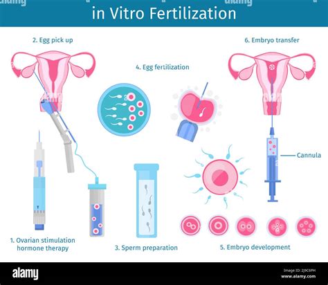 Concept de processus de fécondation in vitro avec étapes de la ...